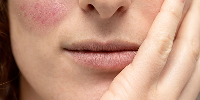 Close-up of woman with rosacea.