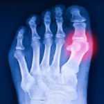 X-ray showing high uric acid and urate crystals in the joints.