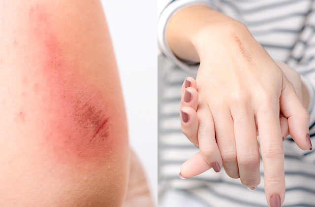 Close-up of burned skin, and woman's hand with burn.